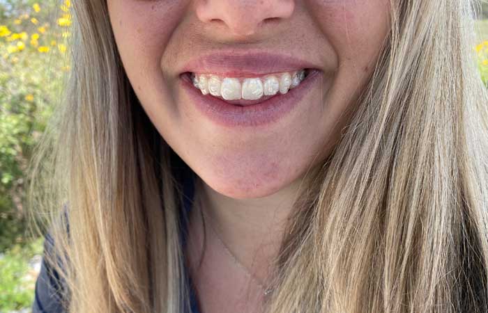 Picture of a woman wearing Invisalign in Gilbert, Arizona