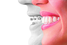 Invisalign  Queen Creek Dental