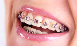 Types of braces - Aspen Orthodontics